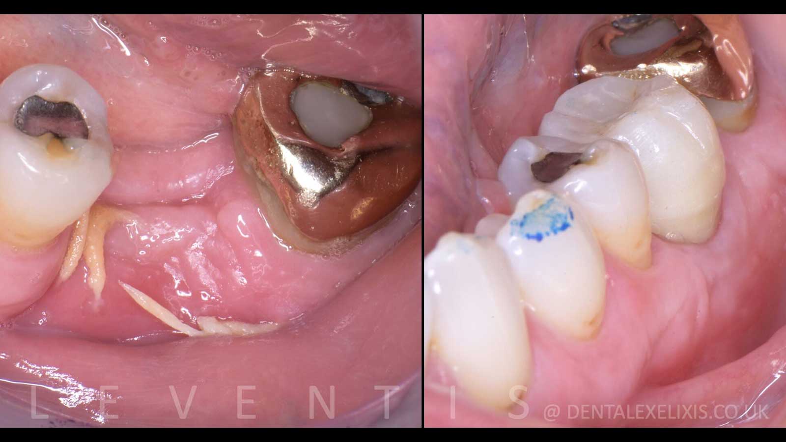 Lower molar early implant placement.