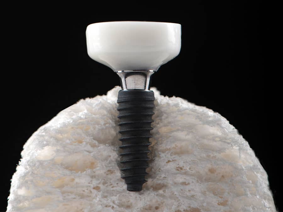 Custom anatomical healing abutment fabricated chairside with the Cervico system by VPI